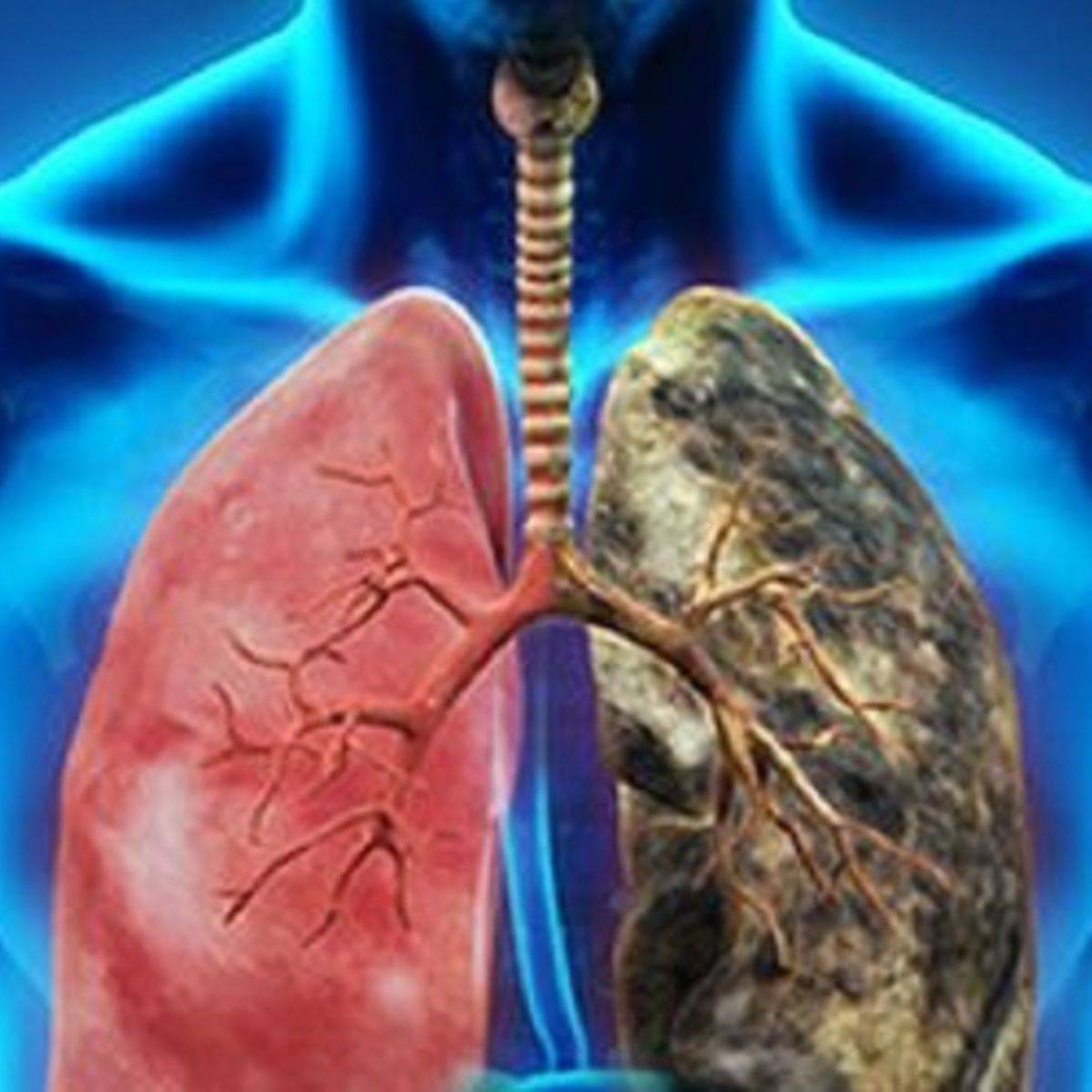 La Unión Europea ha registrado 273.400 muertes por cáncer de pulmón durante 2015.